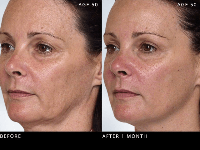 The Liquid Facelift Treatment - Dorset, Bournemouth, Christchurch