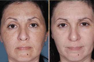 Pigmentation Treatment - Dorset, Bournemouth, Christchurch