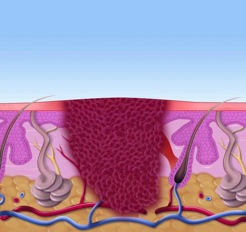 Swift Treatment for warts at Southface Dermatology in Bournemouth ...